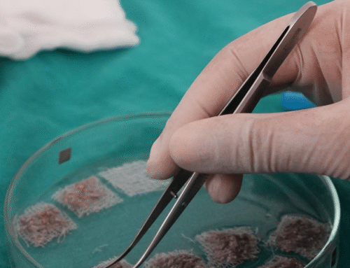 Kaş Ekimi İşlemi: Hastaların Bilmesi Gerekenler