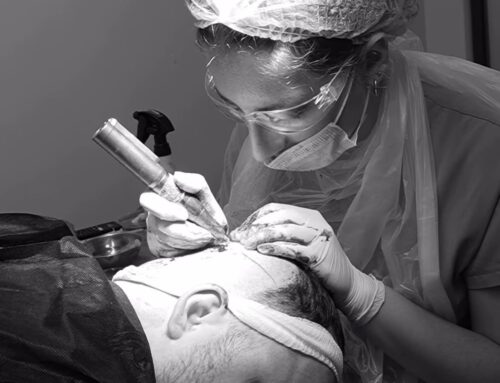 Saç Ekimi Operasyonuna Nasıl Hazırlanılır?