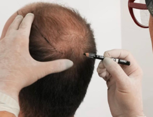 Saç Ekimi Sonrası İlk Haftada Neler Beklenmeli?