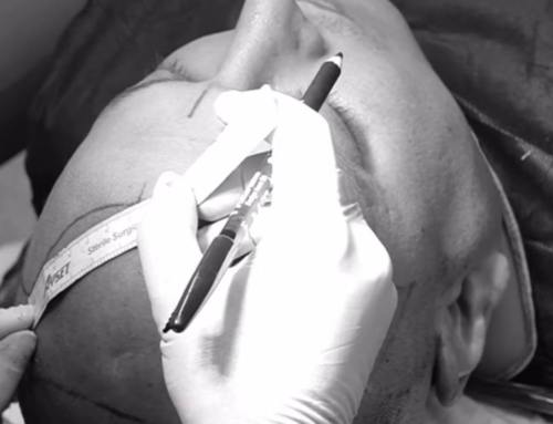 FUE Saç Ekimi: Yeni Başlayanlar İçin Kılavuz