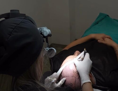 FUE Sonrası İyileşme: İlk 30 Günde Neler Beklenmeli?