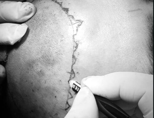 Saç Restorasyonunda “Hair Mill” Ne Anlama Gelir?