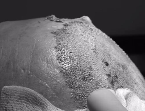 Kadınlarda Saç Seyrelmesinin Sebepleri Nelerdir?