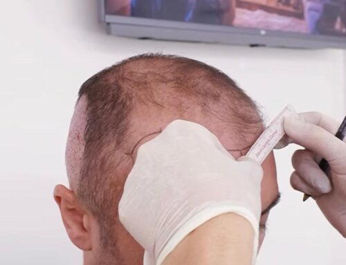 Yaşlanma Saç Dökülmesini Nasıl Etkiler?