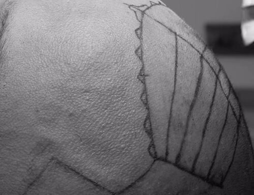 Sigara İçmenin Saç Dökülmesi ve Seyrelmesi Üzerindeki Etkisi