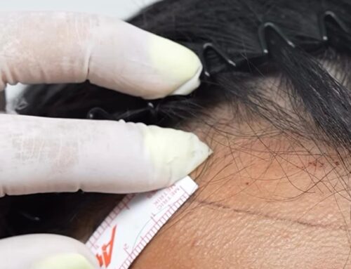 Vücut Kılları Saç Ekimi İçin Kullanılabilir Mi?